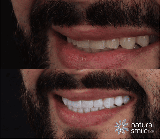 imagem de antes e depois